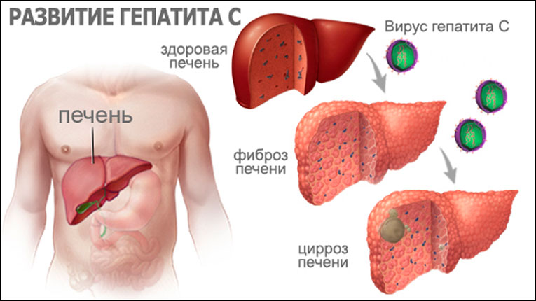 Daclatasvir в Иваново